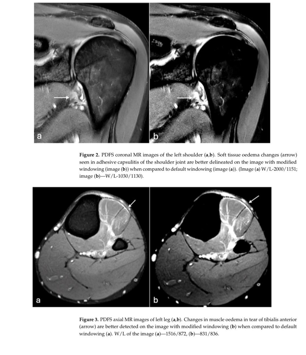 mskradiology4u (@mskradiology4u1) on Twitter photo Latest publication from ROH with collaborators from other institutions mdpi.com/2813-9038/2/3/… <a href="/ROHNHSFT/">The Royal Orthopaedic Hospital</a> <a href="/ROHImaging/">ROHImaging</a> <a href="/ESSRmsk/">European Society of Musculoskeletal Radiology</a> <a href="/MSKSocietyIndia/">MSS India</a> <a href="/intskeletal/">International Skeletal Society | ISS</a> <a href="/Heath_Lodge/">Heath Lodge Clinic</a> <a href="/kartikp31/">K P Iyengar</a> Latest publication from ROH with collaborators from other institutions mdpi.com/2813-9038/2/3/… <a href="/ROHNHSFT/">The Royal Orthopaedic Hospital</a> <a href="/ROHImaging/">ROHImaging</a> <a href="/ESSRmsk/">European Society of Musculoskeletal Radiology</a> <a href="/MSKSocietyIndia/">MSS India</a> <a href="/intskeletal/">International Skeletal Society | ISS</a> <a href="/Heath_Lodge/">Heath Lodge Clinic</a> <a href="/kartikp31/">K P Iyengar</a>