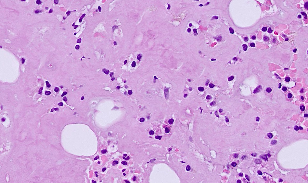 Tiger_heme's tweet image. Bone marrow biopsy. Someone spilled a bucket full of amyloid here.