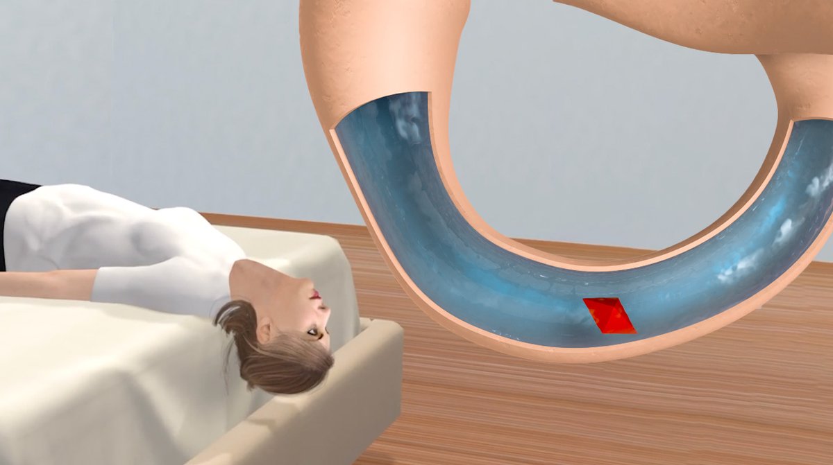 Deep Head Hanging Maneuver to Treat BPPV Vertigo youtu.be/Ci5pzTDUCqc