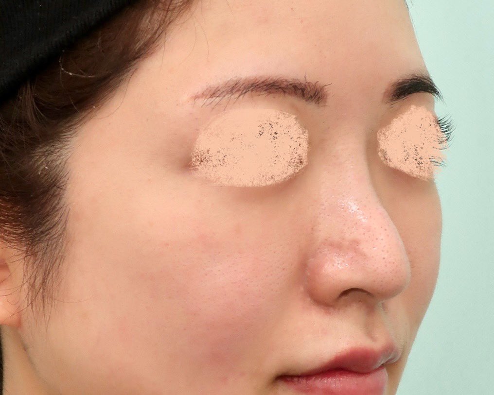 kuma_ishikawa's tweet image. 【ポニーテールリフトの効果について】
ポニーテールリフトは、私がいち早く導入した施術です。韓国でも実施しているドクターはまだ少なく、世界的にも限られた手術であるため、効果を最大限に引き出すために、さまざまな工夫と改良を加えてきました。…