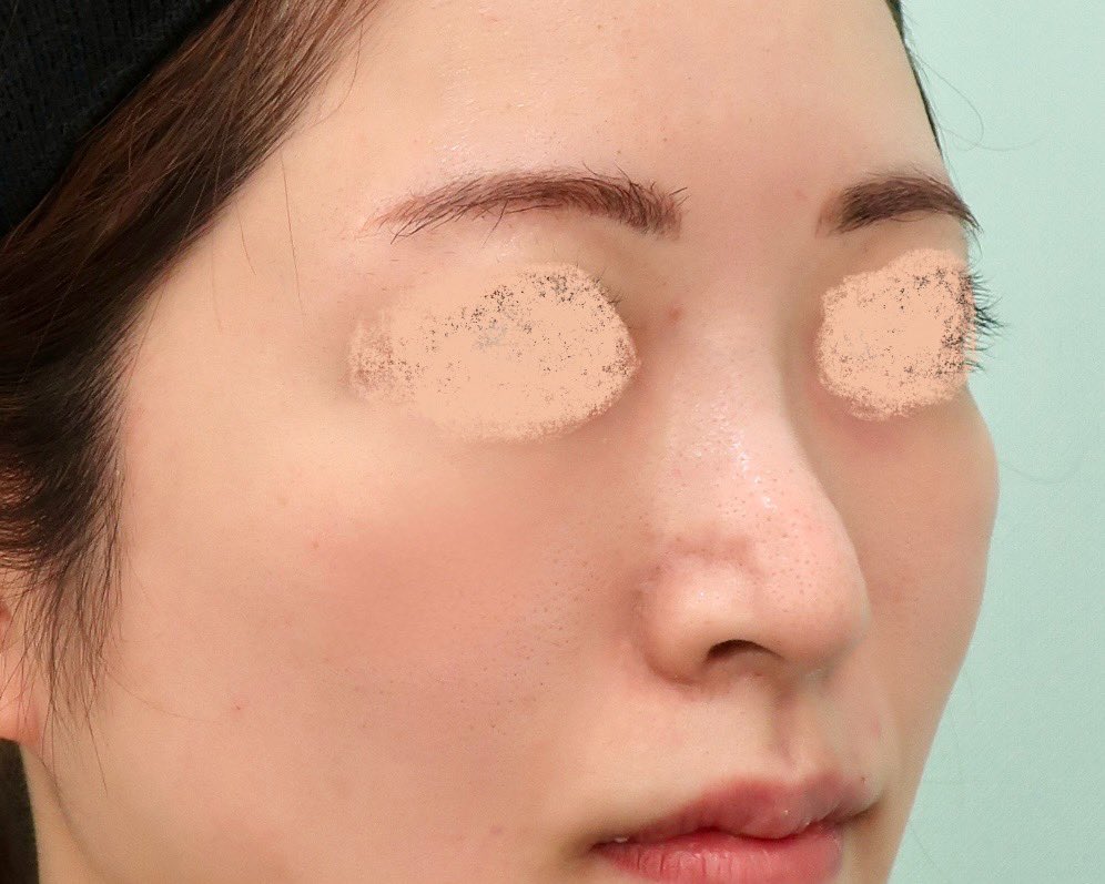 kuma_ishikawa's tweet image. 【ポニーテールリフトの効果について】
ポニーテールリフトは、私がいち早く導入した施術です。韓国でも実施しているドクターはまだ少なく、世界的にも限られた手術であるため、効果を最大限に引き出すために、さまざまな工夫と改良を加えてきました。…