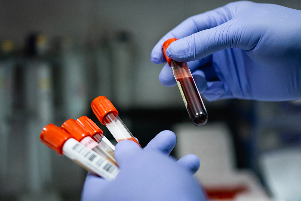 MPN_Hub's tweet image. New data 📝 Phase III VERIFY trial results presented by Andrew Kuykendall at #ASCO2025 show rusfertide achieved a higher response rate vs placebo in patients with PV (76.9% vs 32.9%; p &lt; 0.0001).
Learn more: loom.ly/zUWYo4w
#MPN #mpnsm #MedNews #MedEd