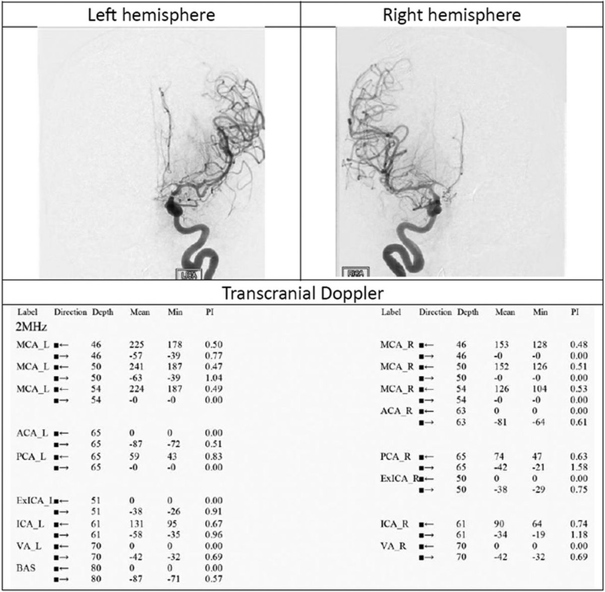 Elevated Flow Velocity in Transcranial Doppler: Discrepancies Between Actual Vasospasm Locations and Flow Measurements | Stroke: Vascular and Interventional Neurology ahajournals.org/doi/10.1161/SV… <a href="/StrokeAHA_ASA/">Stroke AHA/ASA</a> <a href="/SVINJournal/">Stroke: Vascular and Interventional Neurology</a> <a href="/svinsociety/">SVIN</a>