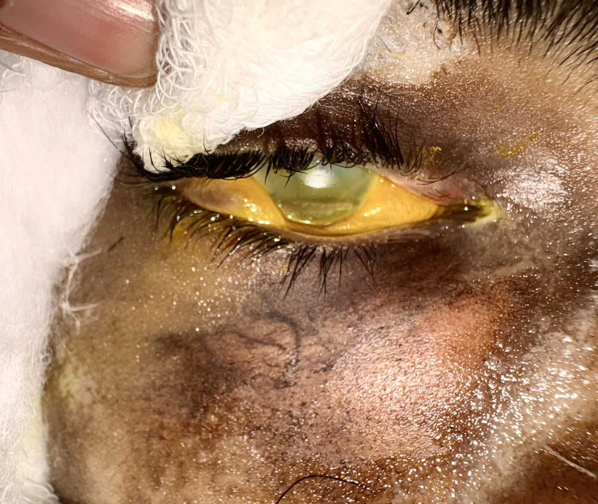drdiazepamdiary's tweet photo. Alleged history of acid attack on body and face involving both eyes (Right>left)

O/E:
🛑Eyelids: Singeing ot eyelashes +
🛑Vision(Right eye): finger counting at 1 metre
🛑360  degree chemosis +
🛑Diffuse corneal haze +
🛑Epithelial defect + https://t.co/LIQ9vrnvb9