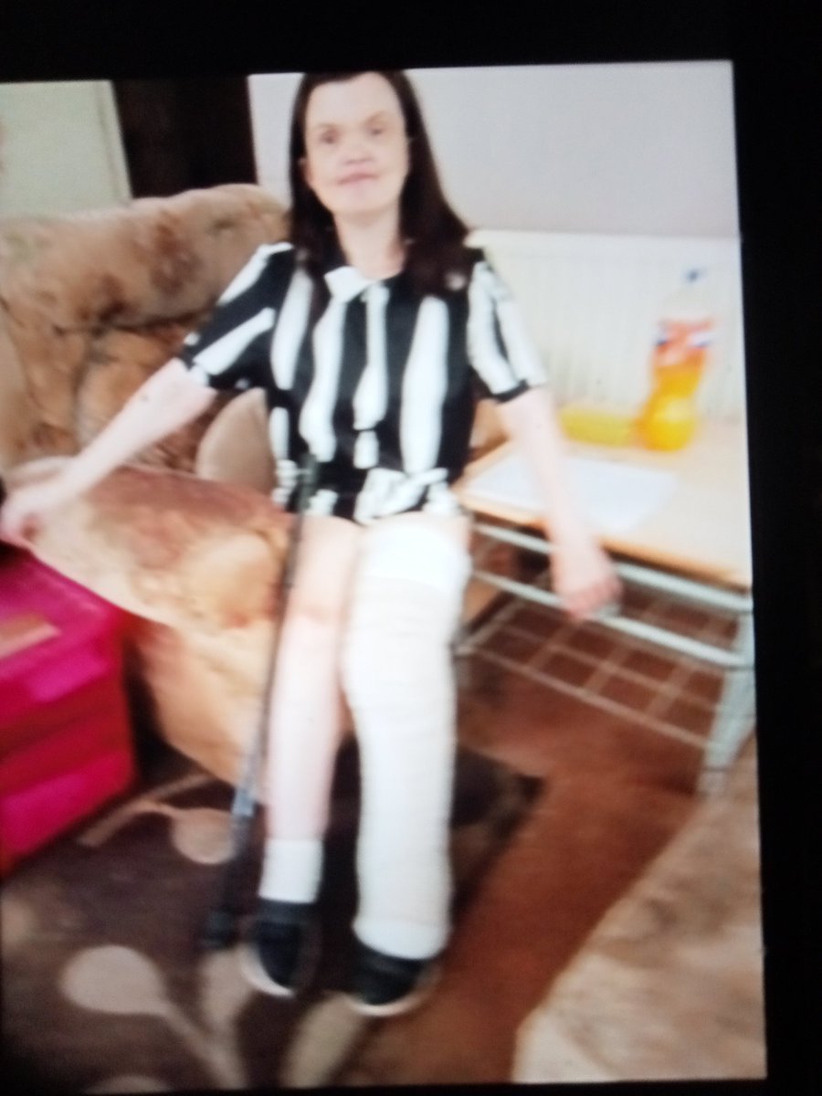 MarieCa88324328's tweet photo. Hi everyone this is Marie from Glasgow here is a photo of me with my left leg heel and Foot badly swollen with Lymphoedema. X https://t.co/lrM5PP0ZKK
