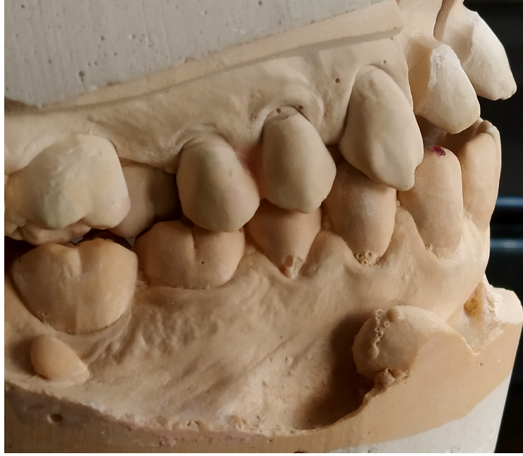 TheLabProtesis's tweet image. Seguramente el dentista te haya hecho un molde de la boca alguna vez, ¿sabías que nosotros posteriormente lo tratamos, y lo usamos para diseñar y fabricar las piezas faltantes?