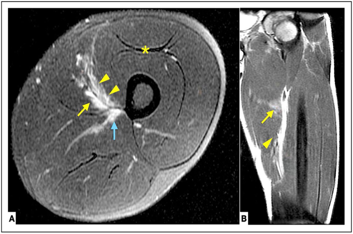 Vastus medialis injury by indirect mechanism in football, a case series. apunts.org/es-vastus-medi…