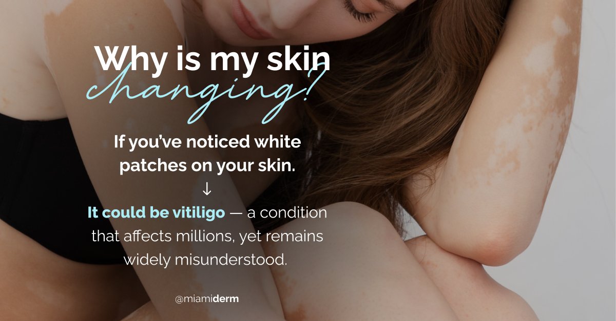 June is #vitiligoawarenessmonth 💜 Explore treatments like Opzelura &amp; Monobenzone. Personalized care is key.

Book your consultation today!
app.squarespacescheduling.com/schedule.php?o…

#vitiligoawareness #dermatologyexpertise #monobenzone