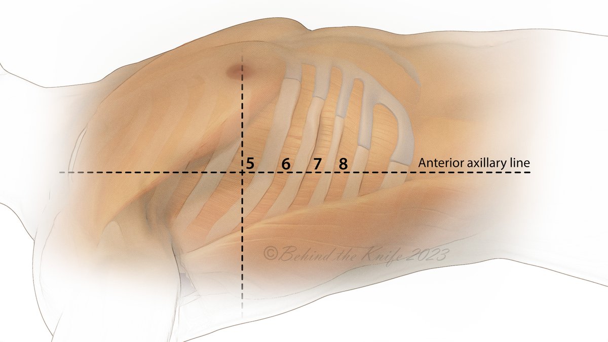 Chest tube insertion is a fundamental skill. Here, we review standard tube thoracostomy:

✔️ For traumatic hemo/pneumothorax, small bore chest tubes are non-inferior to large bore chest tubes ➡️28 Fr is the largest tube you need.
✔️ Insert at intersection of anterior axillary