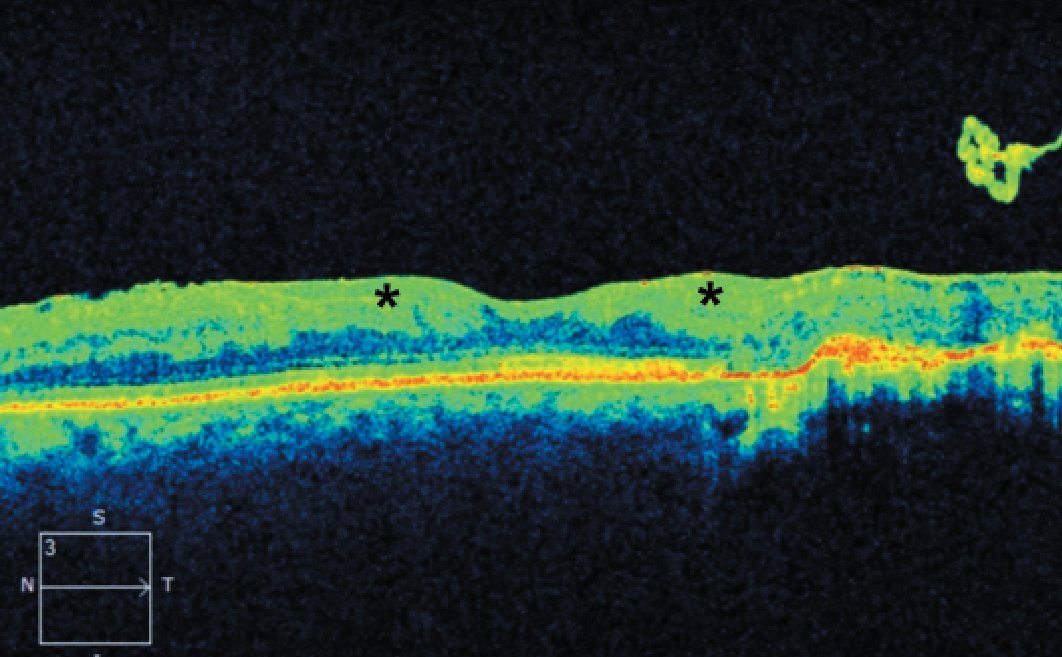 Optical coherence tomography in the management of diabetic retinopathy

Here are tips on what to look for when using this technology to assess and follow patients with DR: retina-specialist.com/article/optica…
#retina #retinaspecialist #ophthalmology #retina #diabeticretinopathy #diabetes