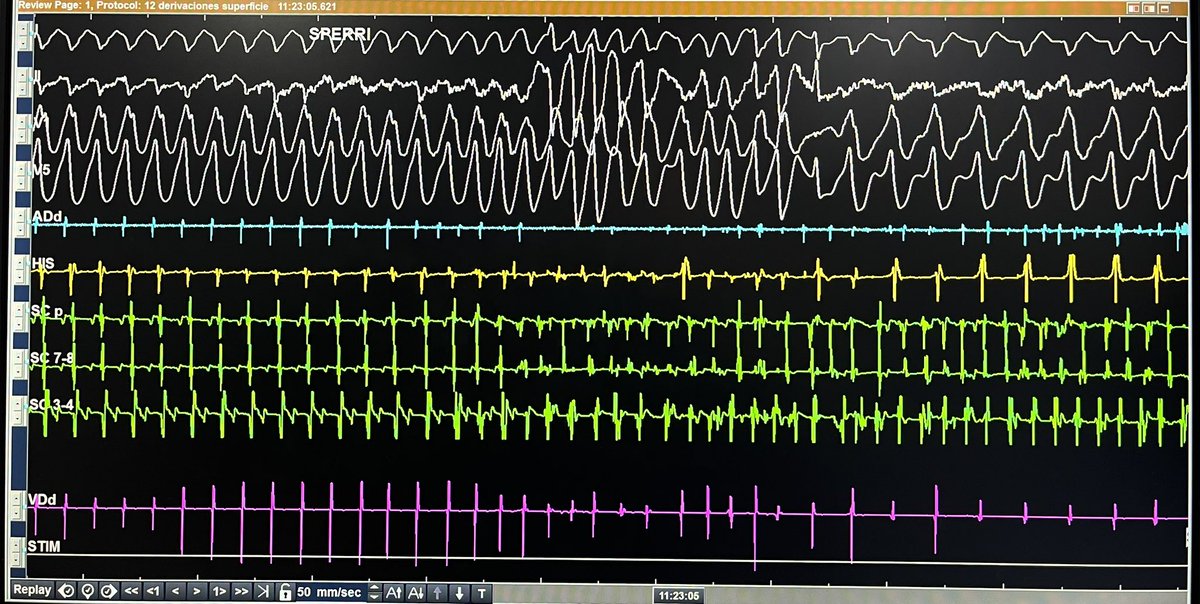 ALBERTO ALFIE (@alfieep1) on Twitter photo In this similar case, there is a preexcited atrial tachycardia after incremental atrial pacing. Thereafter goes into AF
The case of <a href="/melhamriti/">El Hamriti Mustapha</a> is most likely this mechanism. Antidromic reentrant tachycardia usually doesn’t shorten TCL as it seen in AT.
Case done last Thursday In this similar case, there is a preexcited atrial tachycardia after incremental atrial pacing. Thereafter goes into AF
The case of <a href="/melhamriti/">El Hamriti Mustapha</a> is most likely this mechanism. Antidromic reentrant tachycardia usually doesn’t shorten TCL as it seen in AT.
Case done last Thursday