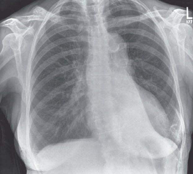 SarMrb's tweet photo. 🫁A 36-year-old woman with well-controlled asthma presents with 2 weeks of worsening dyspnea, wheeze, and productive cough. Vitals stable. Exam: ↓ air entry at L base + expiratory wheeze.

⬇️What does this mean?

#medtwitter #meded #radres #radtwitter #radiology #FOAMed #FOAMrad https://t.co/EJtriIrisH