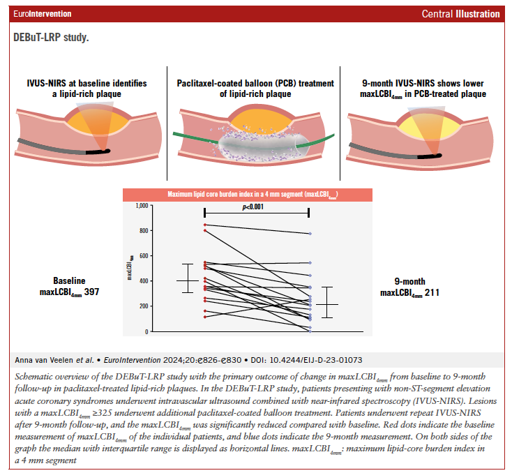 This study explored the use of paclitaxel-coated balloons for stabilizing vulnerable lipid-rich plaques in ACS patients. Discover how this  approach could reduce future coronary events. #Cardiology #ACS
ow.ly/X9pk50SvoNa