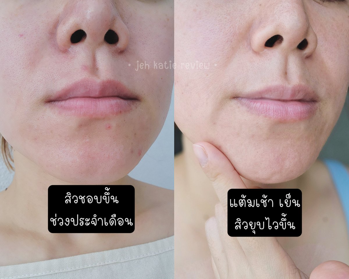 jehkatieee's tweet photo. ไม่ได้อวยนะแต่เ��ลแต้มสิว Pharmular แต้มสิว 3-4 วันระยุบจริง หลอดแค่นี้แต่เริ่ดนะแก! ใช้ได้กับสิวทุกประเภท นอกจากลดสิว ลดรอยสิว รอยแดงรอยดำหลังสิวหายด้วย ตัวเนื้อเจลเข้มข้น แต่ซึมซาบไว ไม่ต้องกลัวแพ้ 🚫น้องปราศจากสี แอลกอฮอล์, ซิลิโคน พาราเบน ไร้กลิ่น ใครมีปัญหาสิวใดๆ ตัวนี้จบจริง รัวมือ👏👏👏
#ดีบอกต่อ