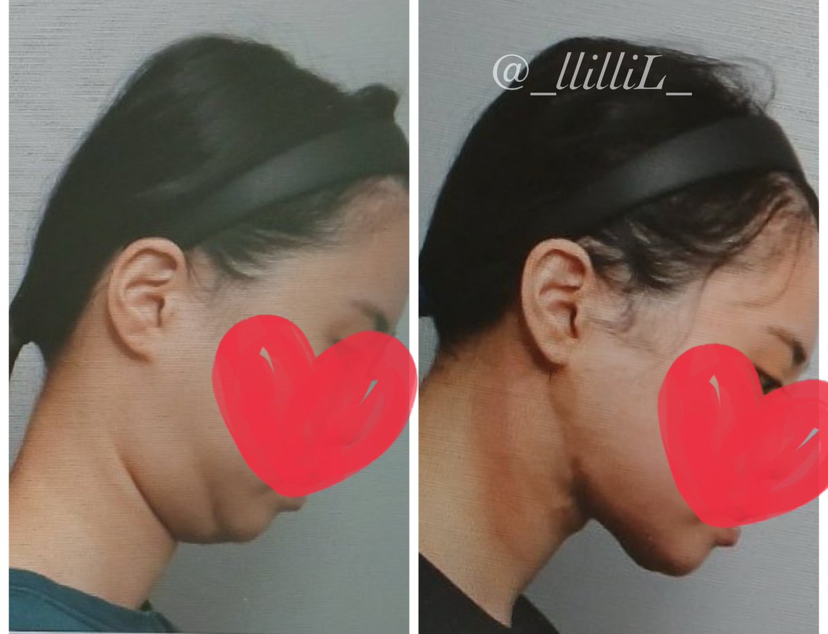 らら@眼瞼下垂失敗から脱却 tweet media