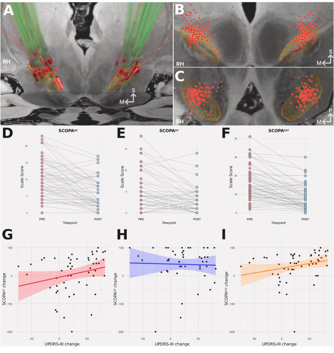 ParkinsonismD's tweet image. Investigating the neural correlates of subjective sleep changes following subthalamic nucleus deep brain stimulation for Parkinson's disease
#neural #sleep #STN #subthalamic #DBS #deepbrainstimulation #PD #Parkinson
@PRDAssociation
Log in:
prd-journal.com/article/S1353-…