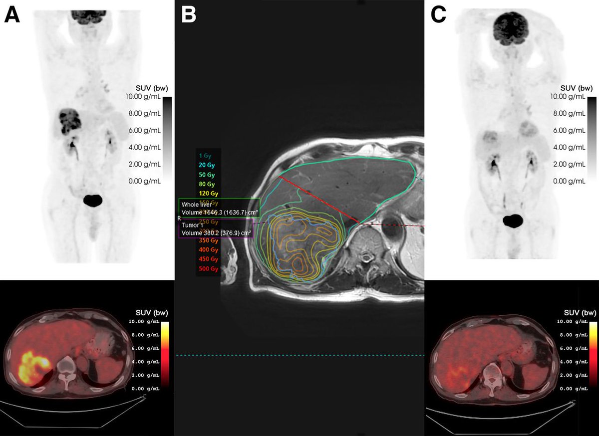 JournalofNucMed's tweet image. What is the mean radiation dose that should be targeted in colorectal carcinoma liver metastases in TARE with ⁹⁰Y glass microspheres? Find out: ow.ly/kC5G50W1AuI

#NuclearMedicine #Dosimetry #ColorectalCancer @fcpiskin @CigdemSoydal