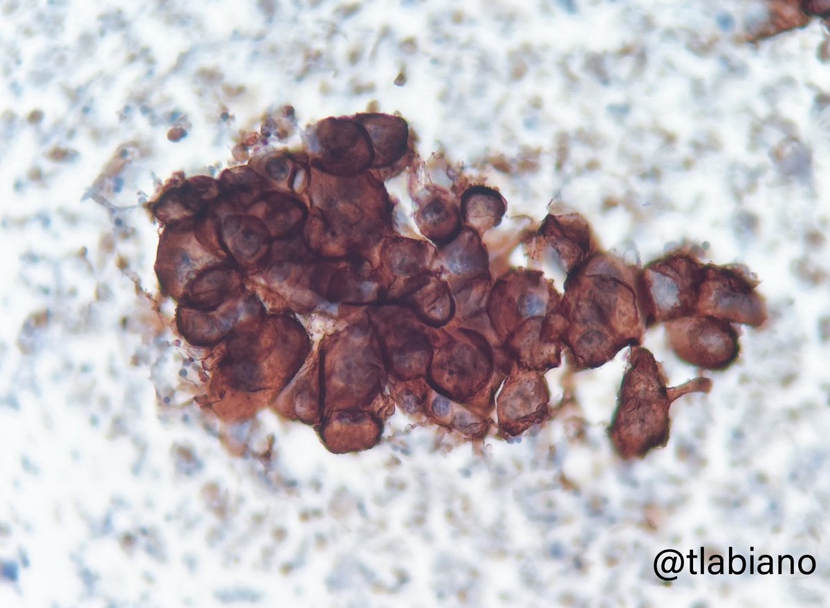 Challenging #FNA #cytology - Apocrine Carcinoma of the breast

🔬Pleomorphic cells w/large nuclei, prominent nucleoli,pink granular cytoplasm.

🏰Arranged in sheets or groups with irregular borders and singly scattered.

🍪HER2 3+ (Androgens +;Estrogen neg).
#breastpath #cytopath
