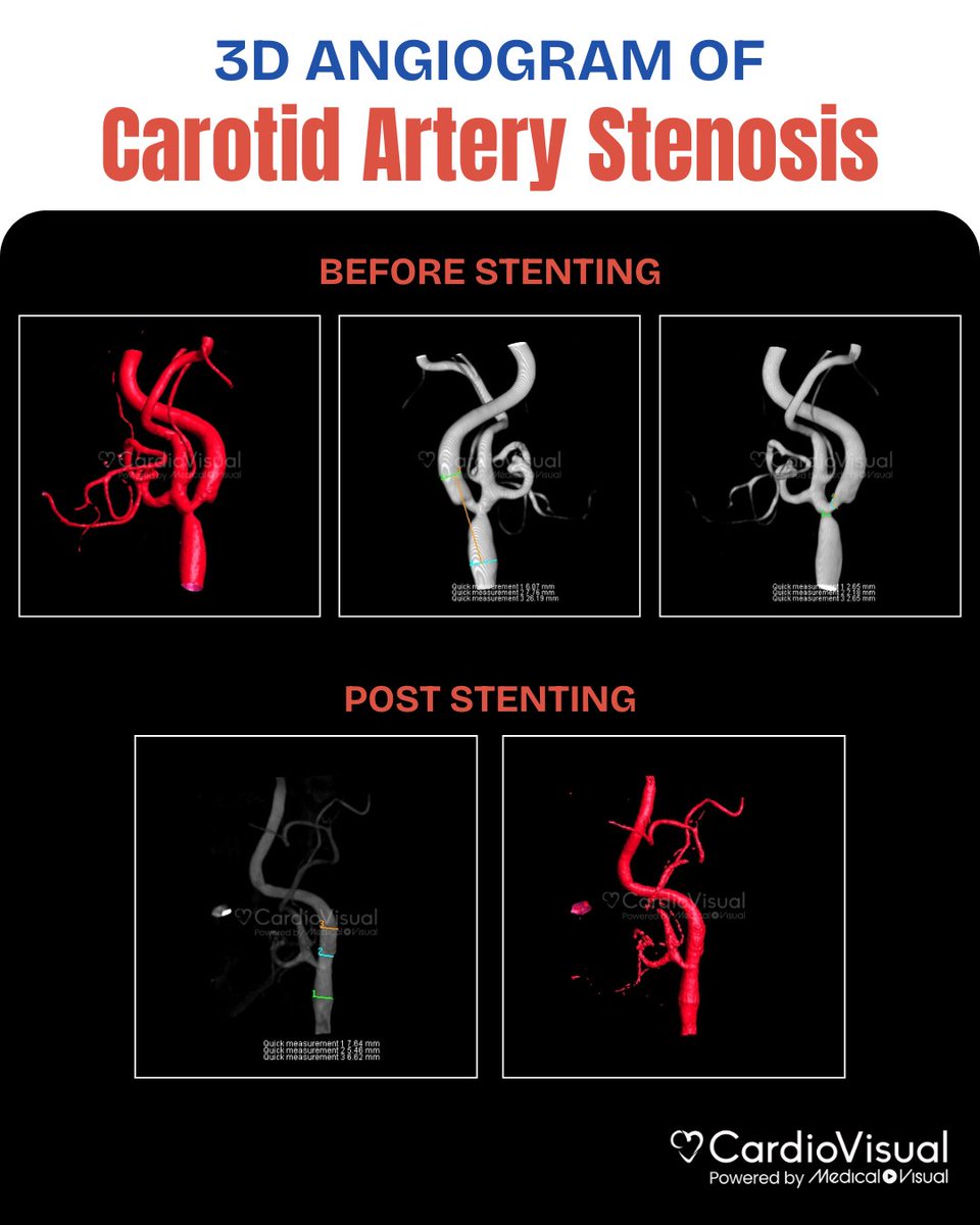 CardioVisualApp's tweet image. Carotid artery stenosis is a stroke risk.
This 3D angiogram shows the artery before &amp; after stenting, with restored flow &amp; preserved side branch.
Minimally invasive stenting can safely treat blockages &amp; prevent strokes.
#StrokePrevention #CarotidStenosis #NeuroIntervention