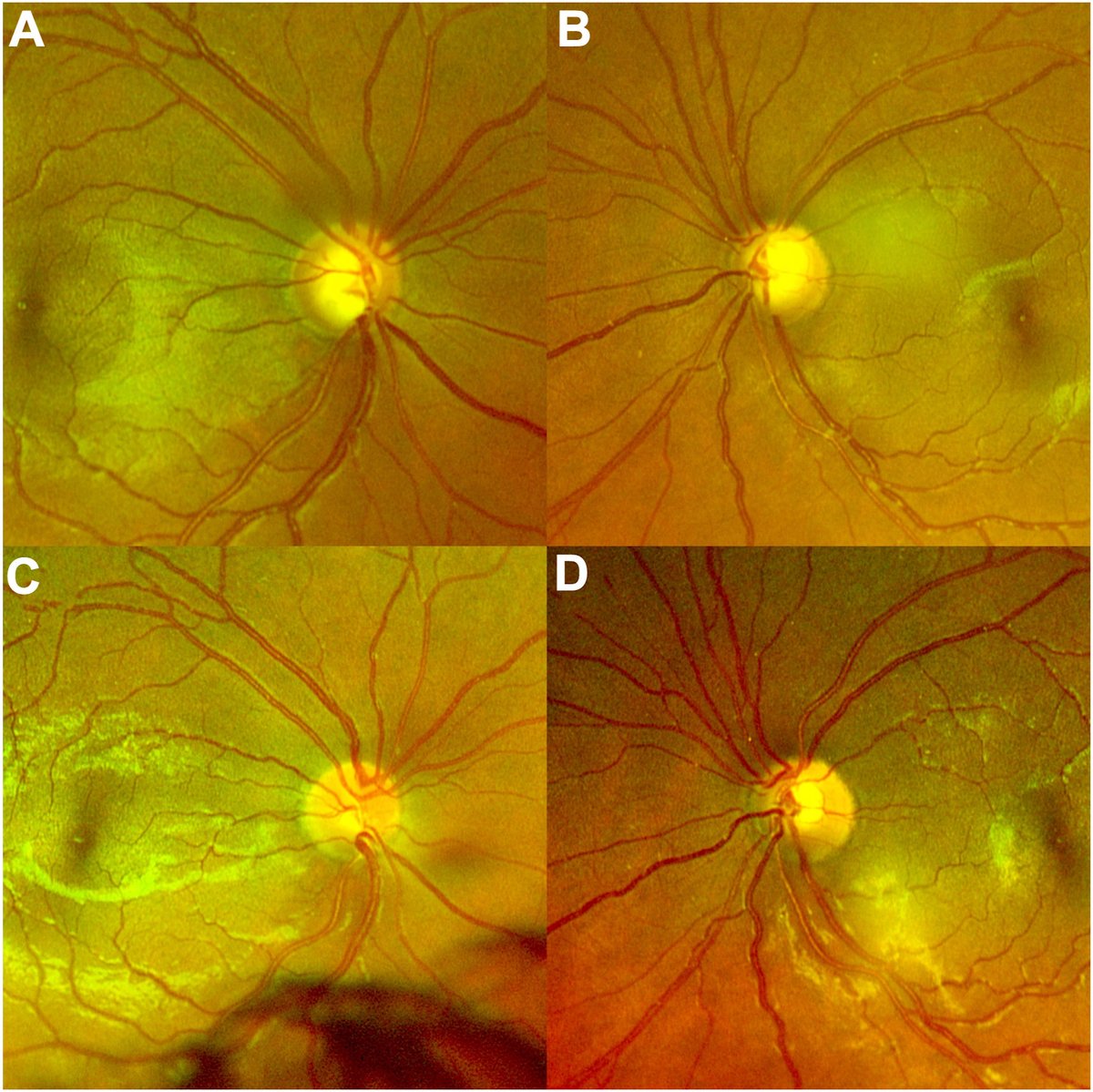 A 23-year-old man presented with vernal keratoconjunctivitis with steroid-induced glaucoma in both eyes. Intraocular pressure was right eye (OD) 40 mmHg, left eye (OS) 42 mmHg. Significant optic nerve head (ONH) cupping was noted in both eyes (A, OD; B, OS). Topical steroids were