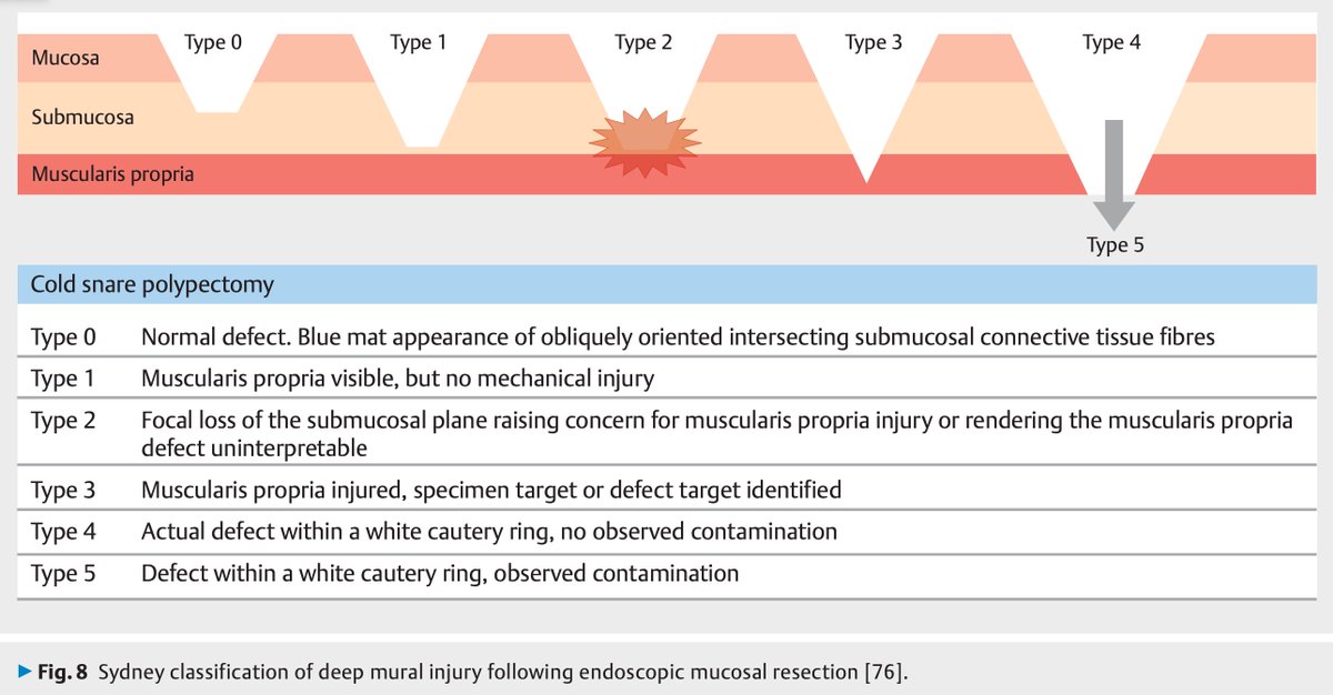 Colorectal polypectomy: ESGE Guideline 2024 - a must read for trainees and polyp enthusiasts! 🍄🔦

1️⃣ Algorithm for polyp management
2️⃣ Paris classification (polyp morphology)
3️⃣ JNET classification (optical diagnosis)
4️⃣ Sydney classification (deep mural injury)

📸: