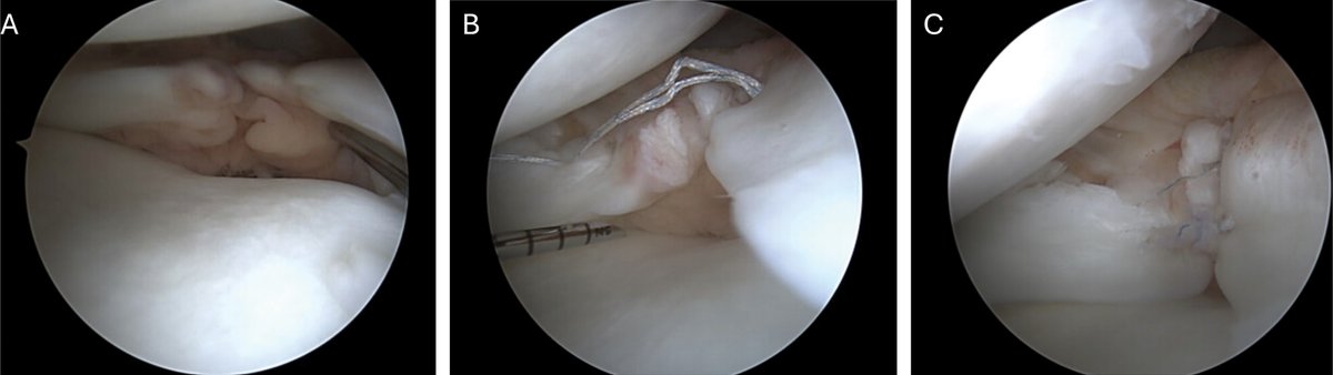 Here’s what you need to know about: Surgical Management of Meniscus Tears: Update on Indications and Techniques for Repair. bit.ly/46criMk @WUSTLortho