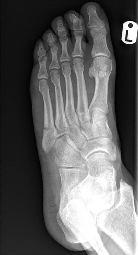 X-RAY QUIZ: Twisting injury. Painful foot. DP and oblique views. Where is the injury? Start Quiz buff.ly/40od46C