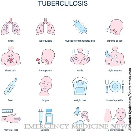Emergency Medicine News (@emnews) on Twitter photo 🚨 TB is back—and not just globally. It’s in our EDs, our waiting rooms, and the corners of our differentials. Read more and earn CME in this month's In Focus from Dr. Rick Pescatore! 📖 @americanthoracic <a href="/Rick_Pescatore/">Rick Pescatore, D.O.</a> <a href="/atscommunity/">American Thoracic Society (ATS)</a>
ow.ly/kl8Z50WiuuL 🚨 TB is back—and not just globally. It’s in our EDs, our waiting rooms, and the corners of our differentials. Read more and earn CME in this month's In Focus from Dr. Rick Pescatore! 📖 @americanthoracic <a href="/Rick_Pescatore/">Rick Pescatore, D.O.</a> <a href="/atscommunity/">American Thoracic Society (ATS)</a>
ow.ly/kl8Z50WiuuL