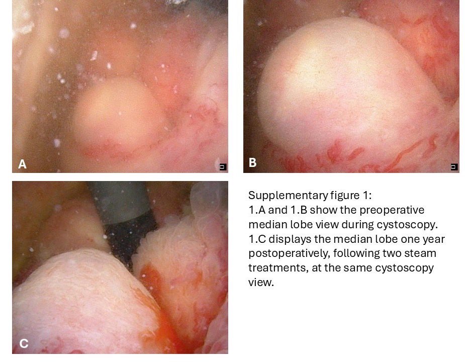 Excited to share our latest publication!

🧵 1/4: Struggling with BPH symptoms, especially with a significant median lobe? 
Standard minimally invasive Rezum therapy can sometimes fall short, this can lead to treatment failures or the need for secondary procedures.