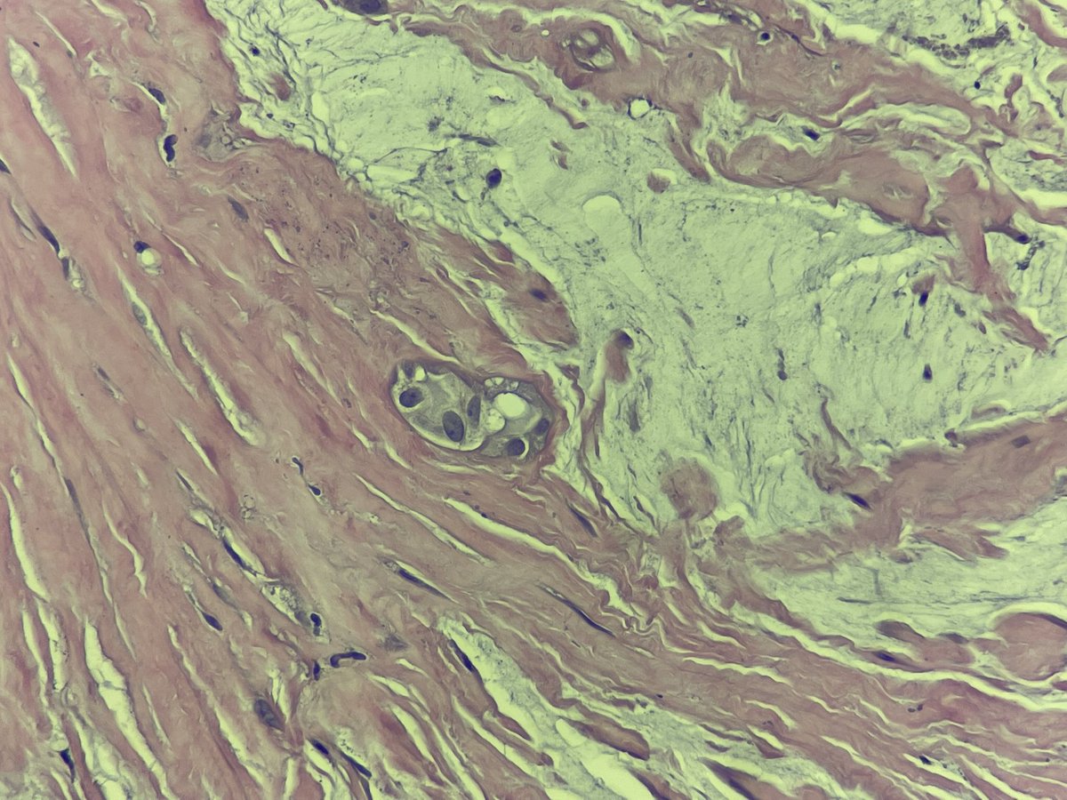 Juggling_path's tweet photo. @slusagar Thank you so much for the suggestion! History of brachytherapy would make sense too. Areas with benign-looking gland structures, and more atypical stromal looking cells. I saw the mucin and 😱. Added the Pax8 will keep you posted! https://t.co/bYBXHMluXv