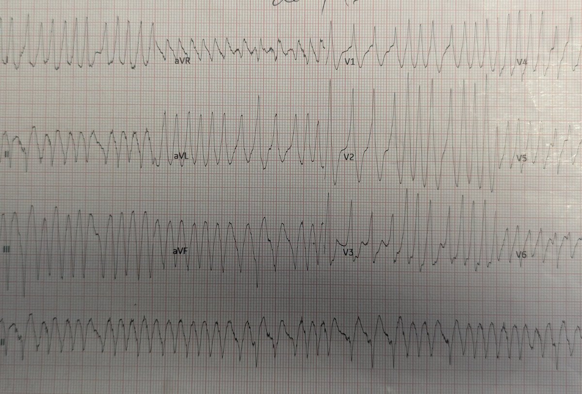 ProfDConnelly's tweet image. My EP journey started as a fellow with @ERowland_Barts on 1st July 1989.
Busy list today to celebrate 36th anniversary -including a pre-excited AF with shortest RR 160ms (CS diverticulum). Nothing is more rewarding to treat!