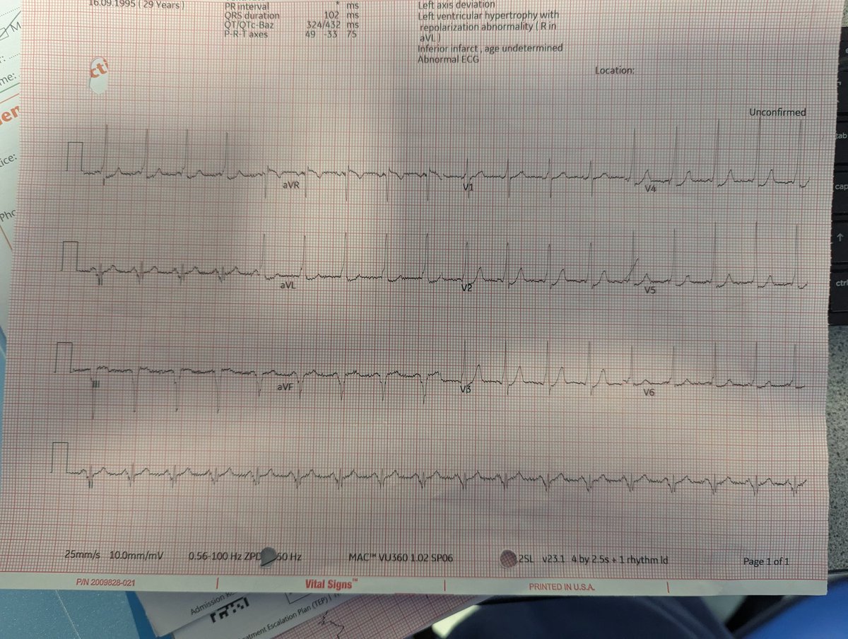 ProfDConnelly's tweet image. My EP journey started as a fellow with @ERowland_Barts on 1st July 1989.
Busy list today to celebrate 36th anniversary -including a pre-excited AF with shortest RR 160ms (CS diverticulum). Nothing is more rewarding to treat!