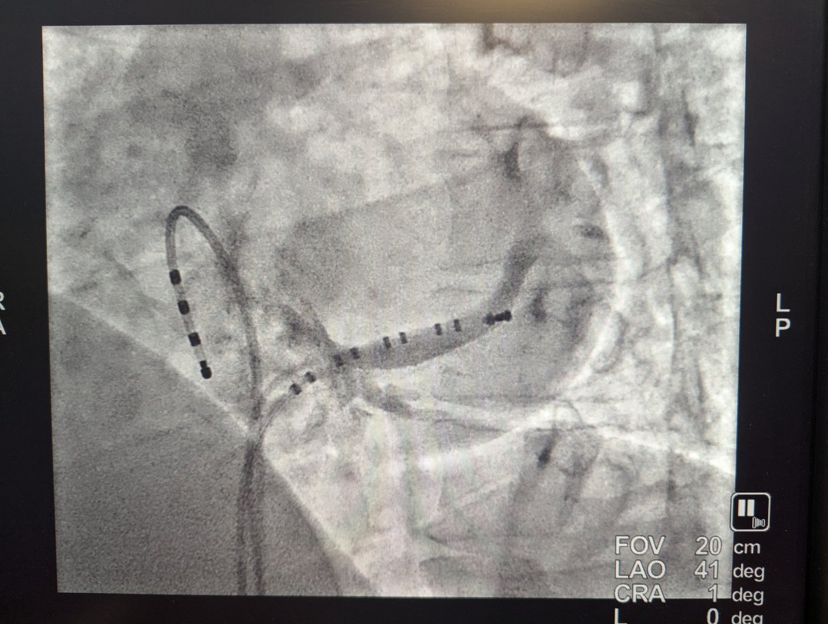 ProfDConnelly's tweet image. My EP journey started as a fellow with @ERowland_Barts on 1st July 1989.
Busy list today to celebrate 36th anniversary -including a pre-excited AF with shortest RR 160ms (CS diverticulum). Nothing is more rewarding to treat!