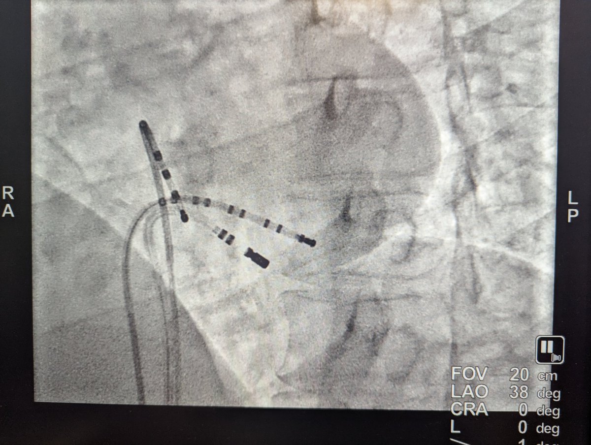 ProfDConnelly's tweet image. My EP journey started as a fellow with @ERowland_Barts on 1st July 1989.
Busy list today to celebrate 36th anniversary -including a pre-excited AF with shortest RR 160ms (CS diverticulum). Nothing is more rewarding to treat!