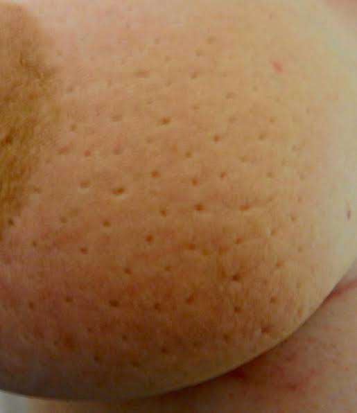 peau de orange .. sign of breast cancer