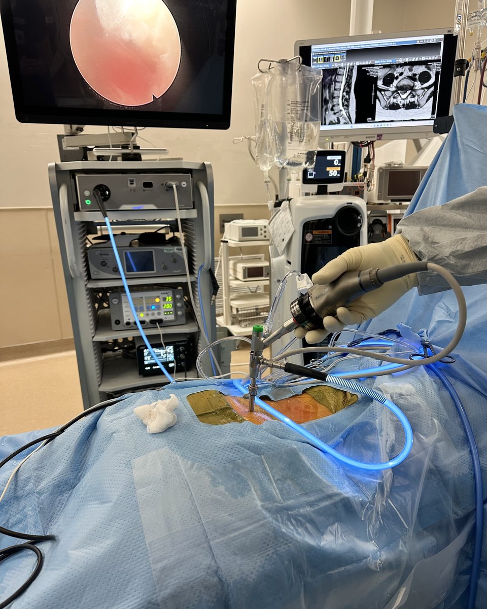 ArthrexSpine's tweet image. Congratulations, Matthew Miller, MD, for completing the first ultra-minimally invasive endoscopic spine surgery in Nebraska!
Dr. Miller, Ortho Nebraska Hospital, performed a L5-S1 discectomy with an interlaminar approach using the Arthrex working channel endoscope and 4K Synergy…