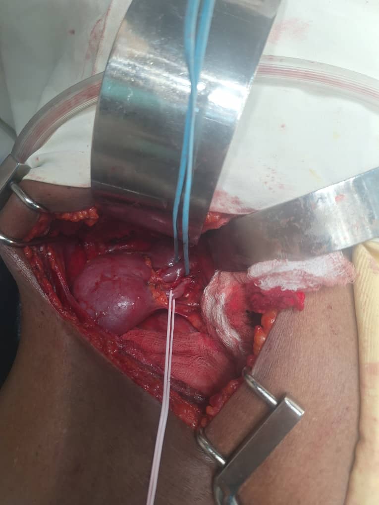 A team led by Dr. Kewani has successfully performed a partial nephrectomy on a 70-year-old patient — a first for Ayder Hospital.
Post-surgical biopsy confirmed:
pT1a Clear Cell Renal Cell Carcinoma (RCC)
Negative resection margin.

Congratulations to the entire surgical team.