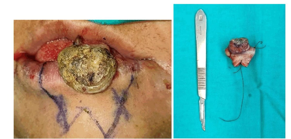 talalshaidar's tweet photo. A 63 year old female patient was referred with fungating lesion in the lower lip that has rapidly enlarged over the last 5 months.

Medical History:
Hypertensive and recent history of Transient Ischaemic Attack.She is on Enalapril, Rosuvastatin, Clopidogrel and Aspirin. She is a known smoker with 10 pack year history.

Extra-oral examination:
A fungating 3x2 cm mass was noted on the lower lip with rolled borders. Clinically no palpable lymph nodes were detected

Intra-oral examination:
No mandibular bony invasion was clinically apparent. The patient had multiple periodontally compromised anterior mandibular teeth. The rest of her jaws were edentulous. 

Special Investigations:
Her baseline bloods were unremarkable and she was RVD non-reactive. Chest radiograph ruled out any distant metastasis in the lungs. An incisional biopsy of the mass was performed under local anaesthesia. 

Diagnosis:
Well differentiated Squamous cell carcinoma of the lower lip (T2N0M0).
Treatment plan  
The plan in consultation with the multidisciplinary oncology team was to perform a wide local excision of the tumour with clear margin. Dentectomy of the lower dentition was also planned. 

Procedure:  
The patient underwent general anaesthesia and 1cm margin was marked out around the tumour. W-incision was marked to aid with closure of the defect post excision. Local anaesthic was infiltrated and en-bloc excision of the tumour was performed. The specimen was orientated and sent for histology . 

Intra-op photograph showing incision marking as well as the specimen. 
Haemostasis was achieved and there was acceptable skin laxity for closure. The defect was closed in 3 layers namely, mucosa intraorally (Vicryl 4/0), orbicularis oris muscle (Vicryl 4/0) and skin (Nylon 5/0) . Steristrip tapping was used to further support the wound. All the mandibular dentition were removed as planned. 
There were no intra-operative complications.

Surgical defect of more than 50% of lower lip and post closure of defect. 

Post-operative:
The patient was discharged on day 1 post op without any concerns. 

Follow-up:
The patient was follow-up one-week post-surgery for removal of sutures and there were no concerns. The patient was followed up every 3 months to assess for any clinically palpable nodes and at the 3rd follow-up visit no abnormalities were detected

Five months post-op photographs showing good aesthetic outcome and no sign of recurrence in the lower lip region.