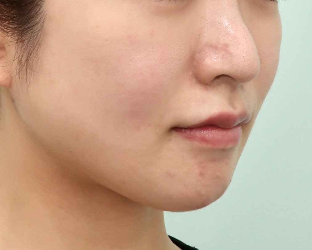 dr__ishikawa's tweet image. About the Effects of the Ponytail Lift

One of the most distinctive features of this lift is its pronounced effect on the midface. In addition, it provides a noticeable lifting effect along the facial contour and the temporal region.
#ponytaillift #PonyTail