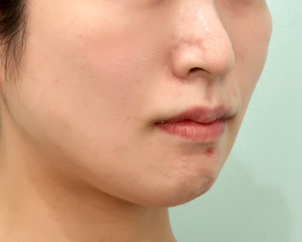 dr__ishikawa's tweet image. About the Effects of the Ponytail Lift

One of the most distinctive features of this lift is its pronounced effect on the midface. In addition, it provides a noticeable lifting effect along the facial contour and the temporal region.
#ponytaillift #PonyTail