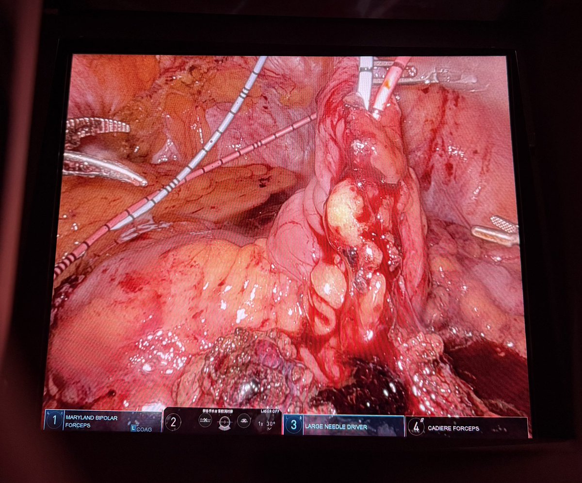Bilateral ureteral strictures with ureteroileal fistula and long ileal diverticulum after RARC with cutaneous ureterostomy

Performed RA ileal conduit and removed the fistula site and ileal diverticulum