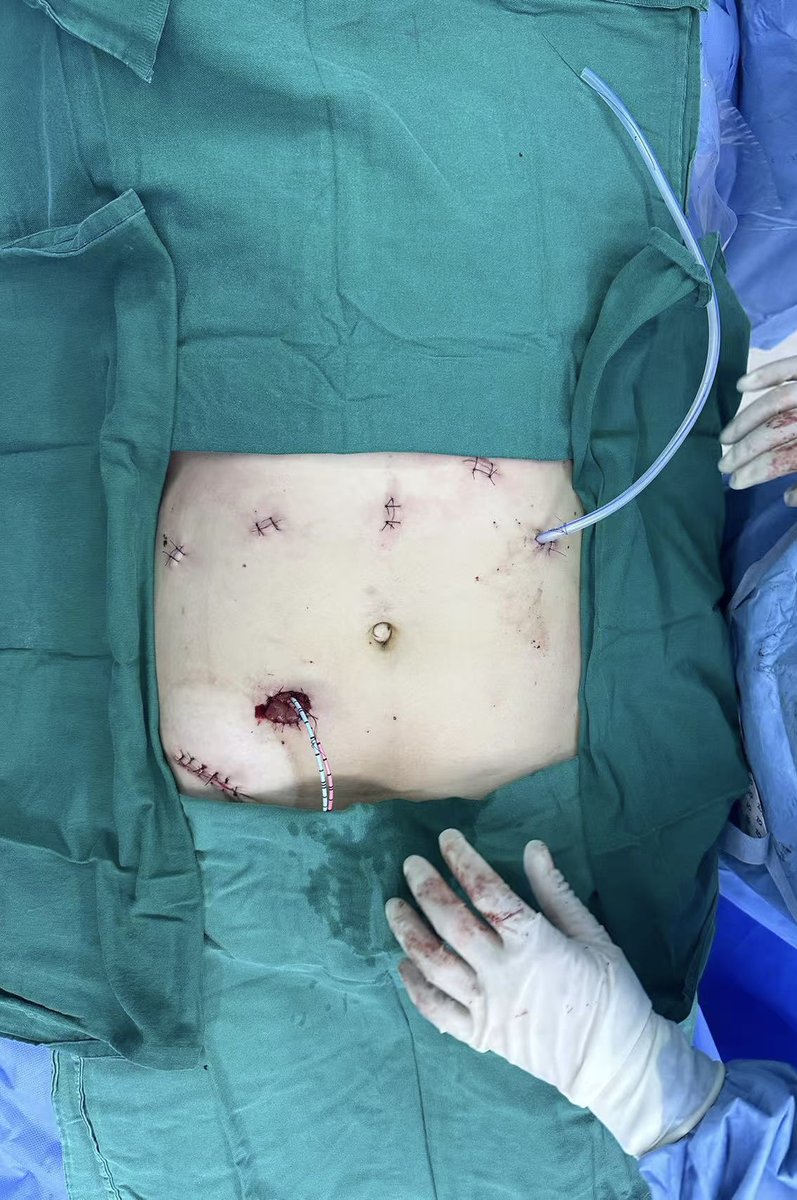 Totally intracorporeal. The robotic approach has absolutely advantages in these complex cases.