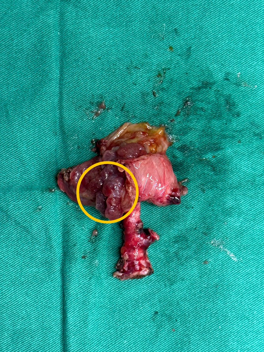 Ureteroileal fistula