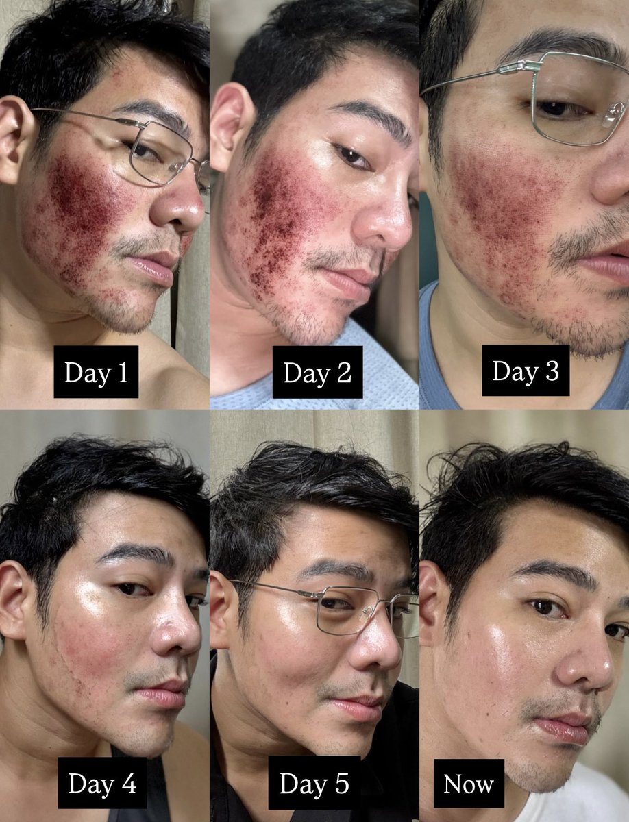 Pico Second Laser ที่ BetterKhun Clinic ตามรักษาหลุมสิวกับหมอขุนมาตั้งแต่ที่เก่าแล้วค้าบ รอบนี้หมอยิงเกลี่ยพื้นผิวหลุมจิกตื้น ๆ บนผิว เลยมีบริเวณที่ยิงแรง อาจจะดูน่ากลัวช่วงทำเสร็จ แต่ผลลัพธ์ก็คือ ผิวใส ชอบมาก แล้วรอการสร้างคอลลาเจนไปอีก บอกเลย จึ้ง