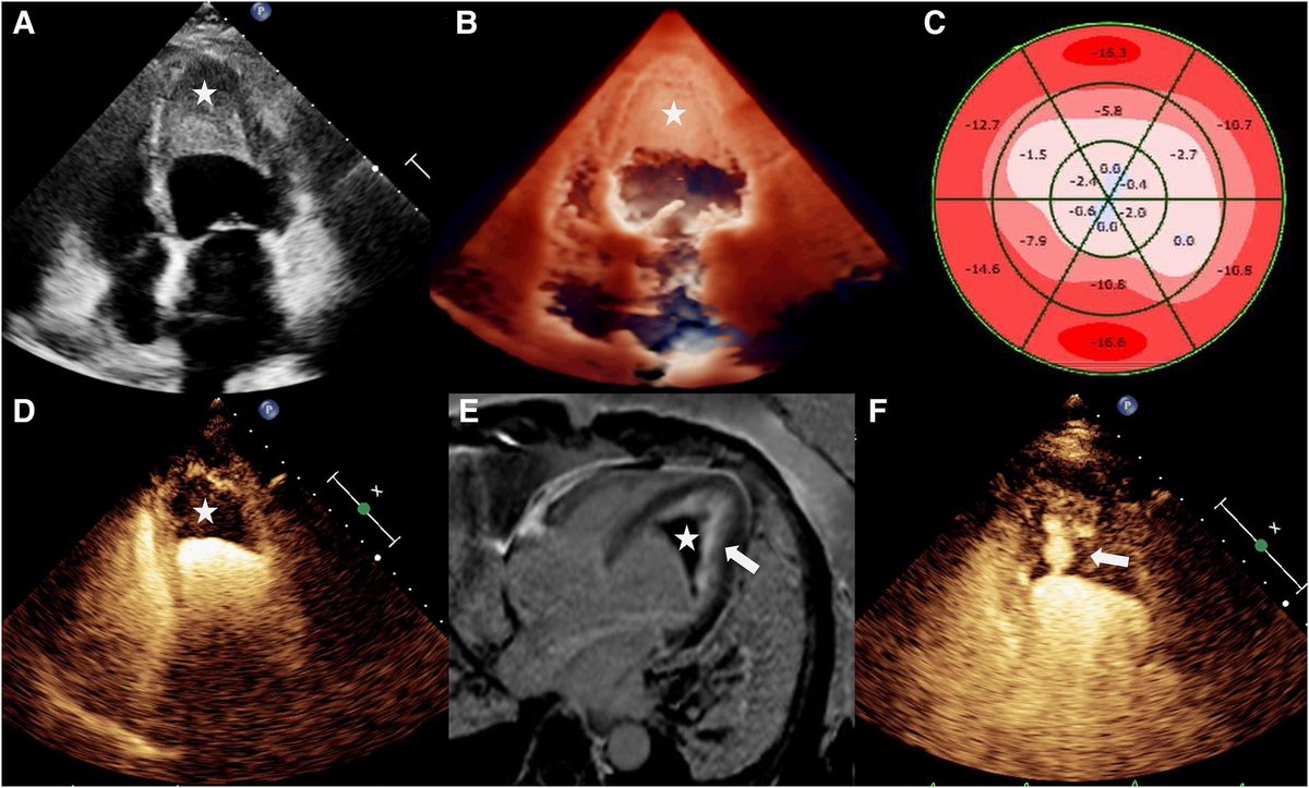 EHJCVIEiC's tweet image. 🚨 A 63-year-old 🧑🦳 with a 2-year history of allergic asthma presented with 10-day chest tightness & dyspnoea. Multiparametric imaging revealed Löffler’s endocarditis 🫀
📚 Yangjie Xiao et al. 🔗 doi.org/10.1093/ehjci/…
🧵 via @EHJCVIEiC #echofirst #LöfflerEndocarditis #EHJCVI