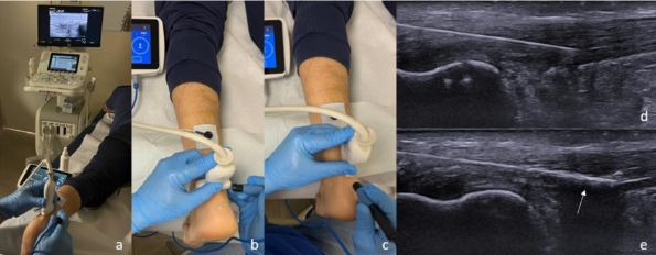 ELECTROLISIS Y TENDINOPATÍA AQUÍLEA

¿El ejercicio excéntrico se te queda corto para la tendinopatía de Aquiles? 

Un ensayo clínico piloto italiano acaba de demostrar que 3 micro-sesiones de electrólisis galvánica ecoguiada pueden darle el empujón que faltaba.

🧵