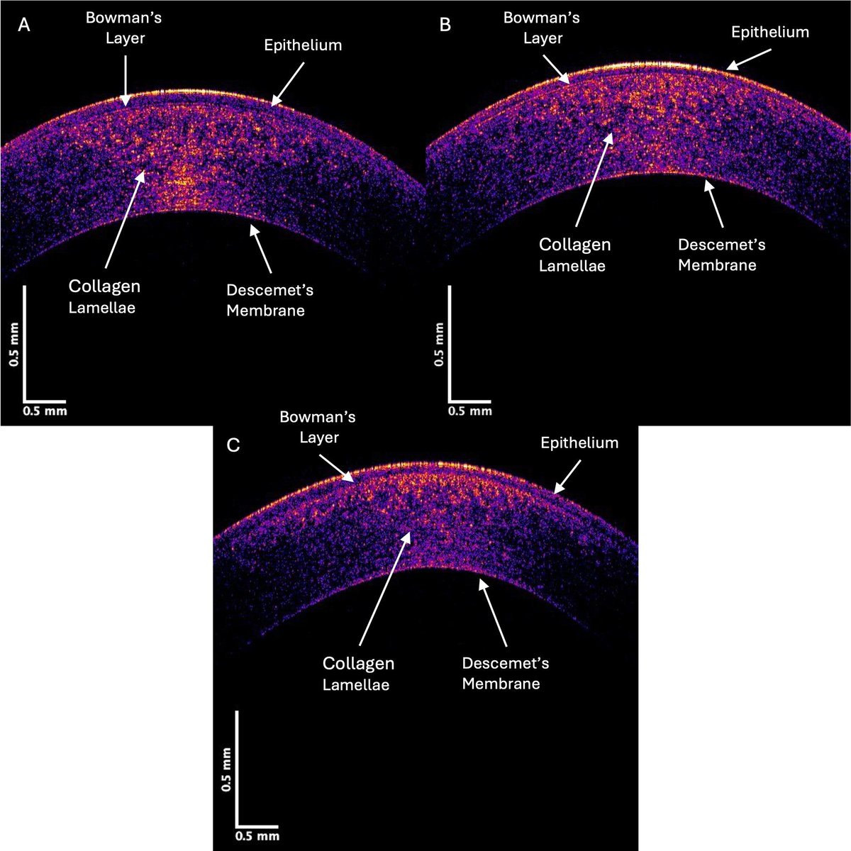 Landmark_IMR's tweet image. Frontiers in Bioscience-Landmark New article is published:
🌟Changes in Corneal Keratocytes and Collagen Fibrils as an Indicator of Keratoconus Onset: A Preliminary Study Based on OCT Subchannel Images
imrpress.com/journal/FBL/30…
👨🎓 Frederick H Silver, Dominick Benedetto, Tanmay…