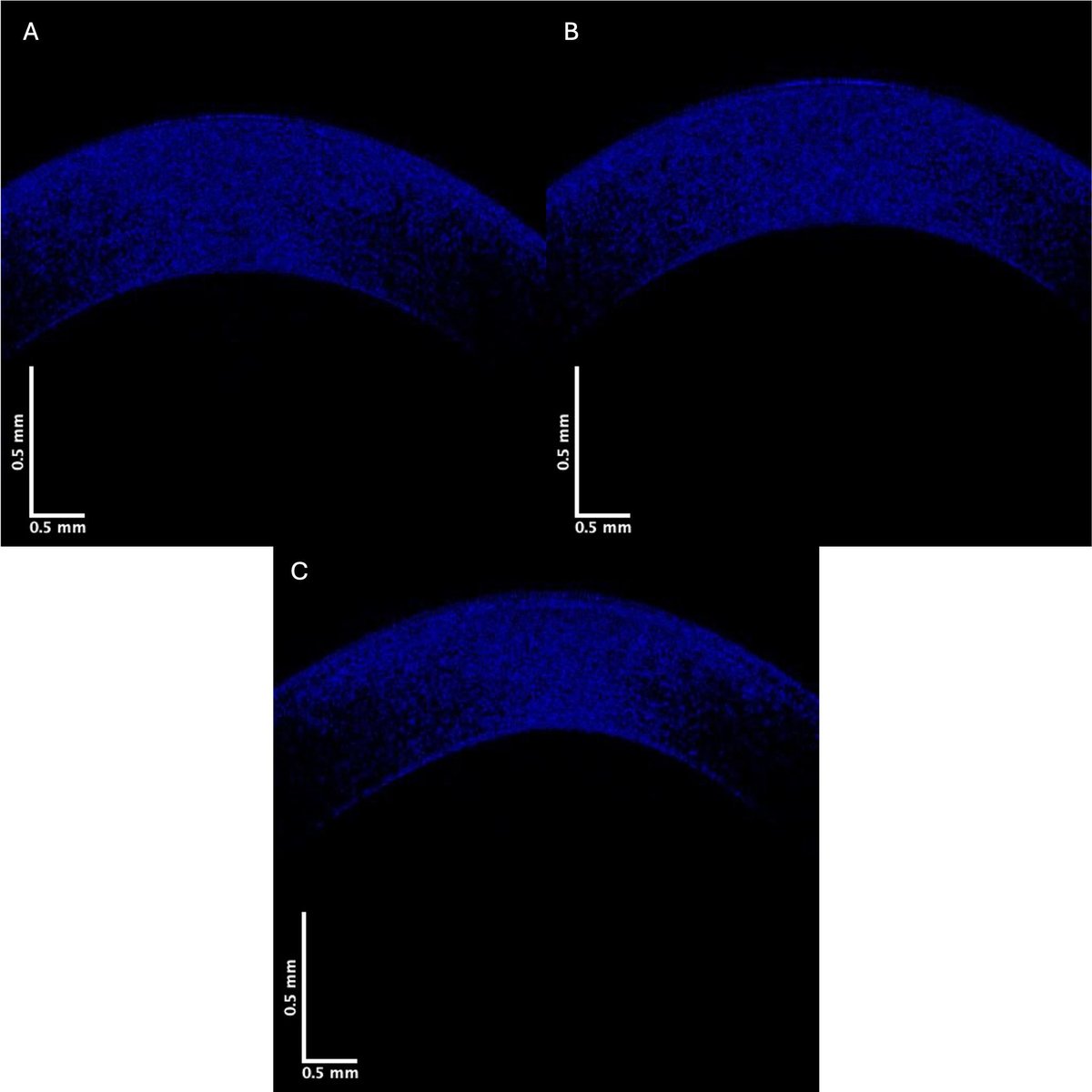 Landmark_IMR's tweet image. Frontiers in Bioscience-Landmark New article is published:
🌟Changes in Corneal Keratocytes and Collagen Fibrils as an Indicator of Keratoconus Onset: A Preliminary Study Based on OCT Subchannel Images
imrpress.com/journal/FBL/30…
👨🎓 Frederick H Silver, Dominick Benedetto, Tanmay…