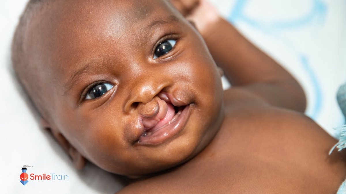 Smile Train UK (@smiletrainuk) on Twitter photo This July, we celebrate National Cleft and Craniofacial Awareness and Prevention Month.
We're focusing on the incredible impact of the comprehensive cleft care our local medical partners provide. Your support helps transform lives and create bright, healthy futures. This July, we celebrate National Cleft and Craniofacial Awareness and Prevention Month.
We're focusing on the incredible impact of the comprehensive cleft care our local medical partners provide. Your support helps transform lives and create bright, healthy futures.