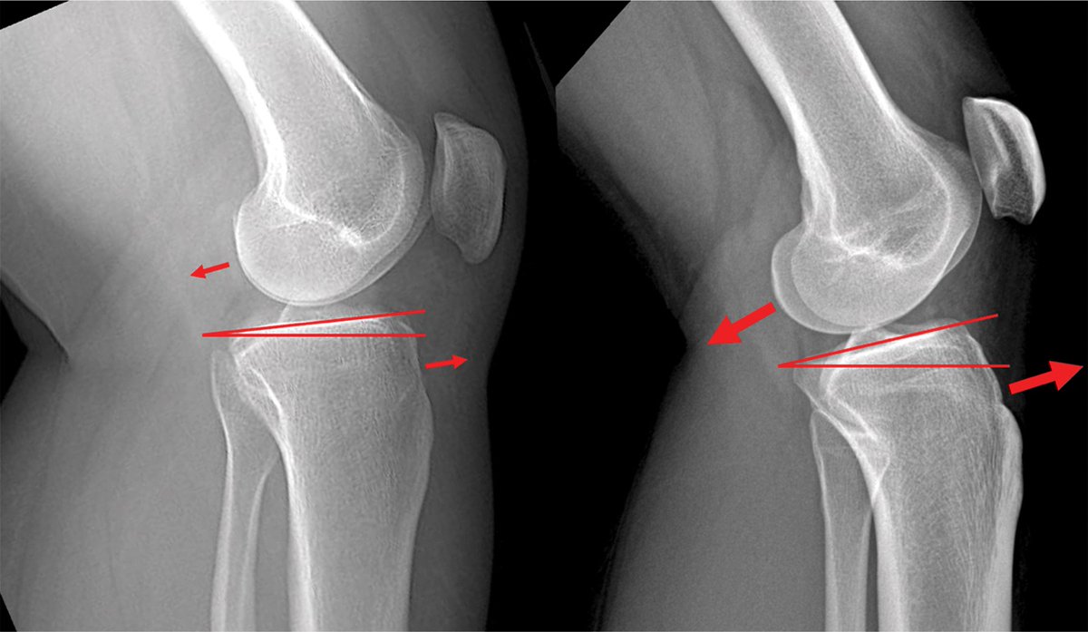 Exploring the latest research: Primary Anterior Cruciate Ligament Injury: Extrinsic and Intrinsic Risk Factors. bit.ly/3ZT0dtD